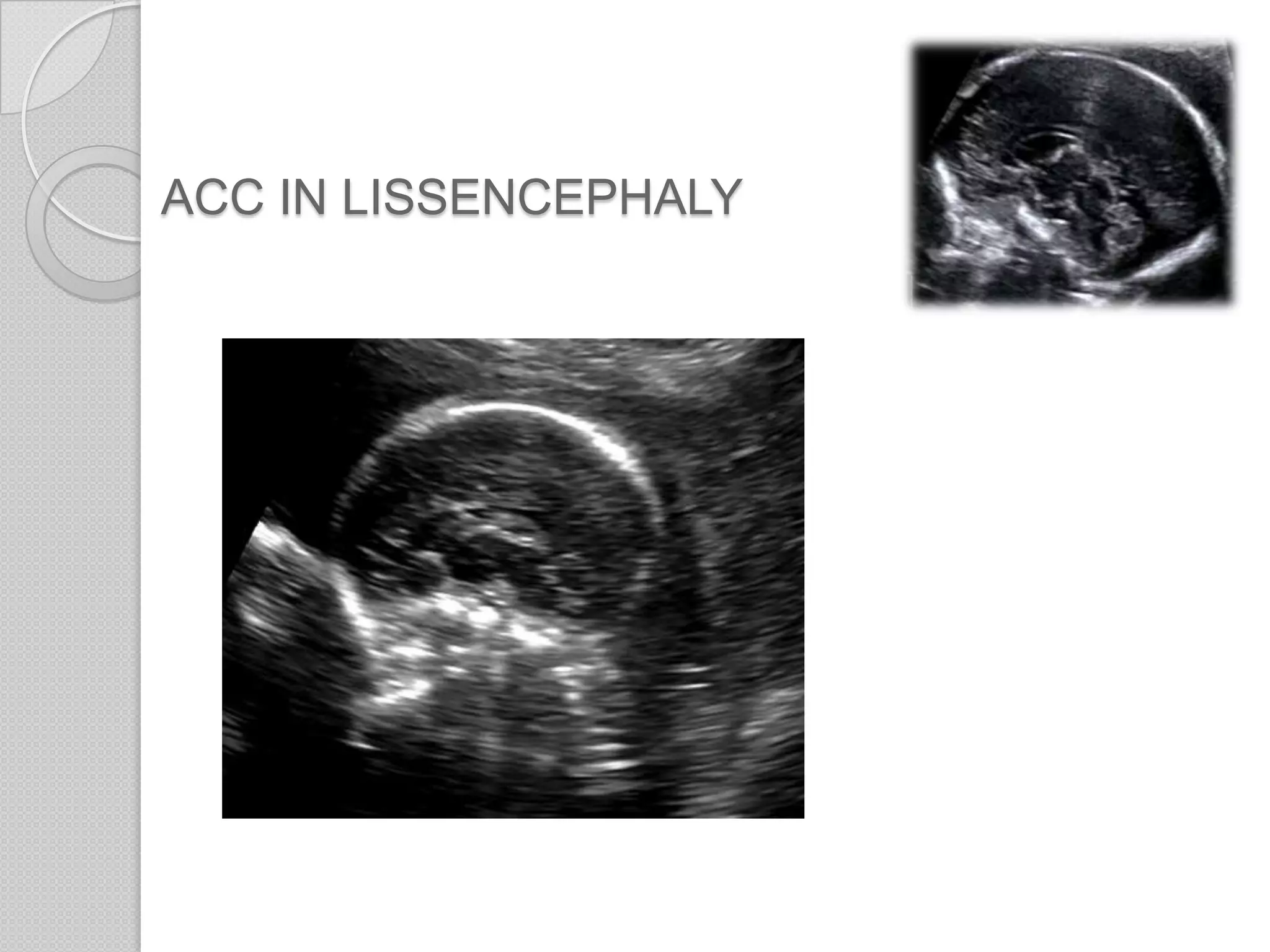 ACC IN LISSENCEPHALY
 
