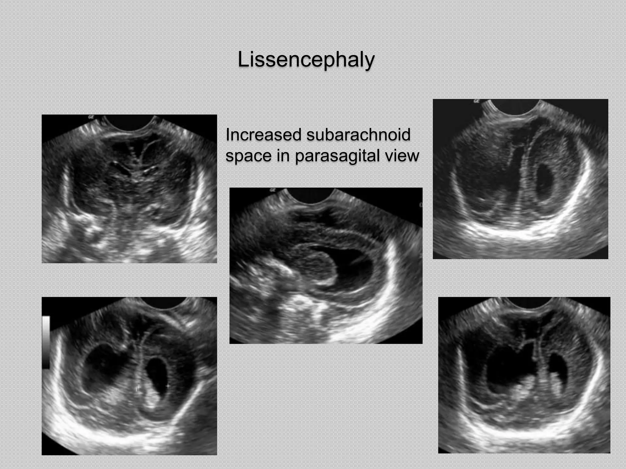 Lissencephaly
Increased subarachnoid
space in parasagital view
 
