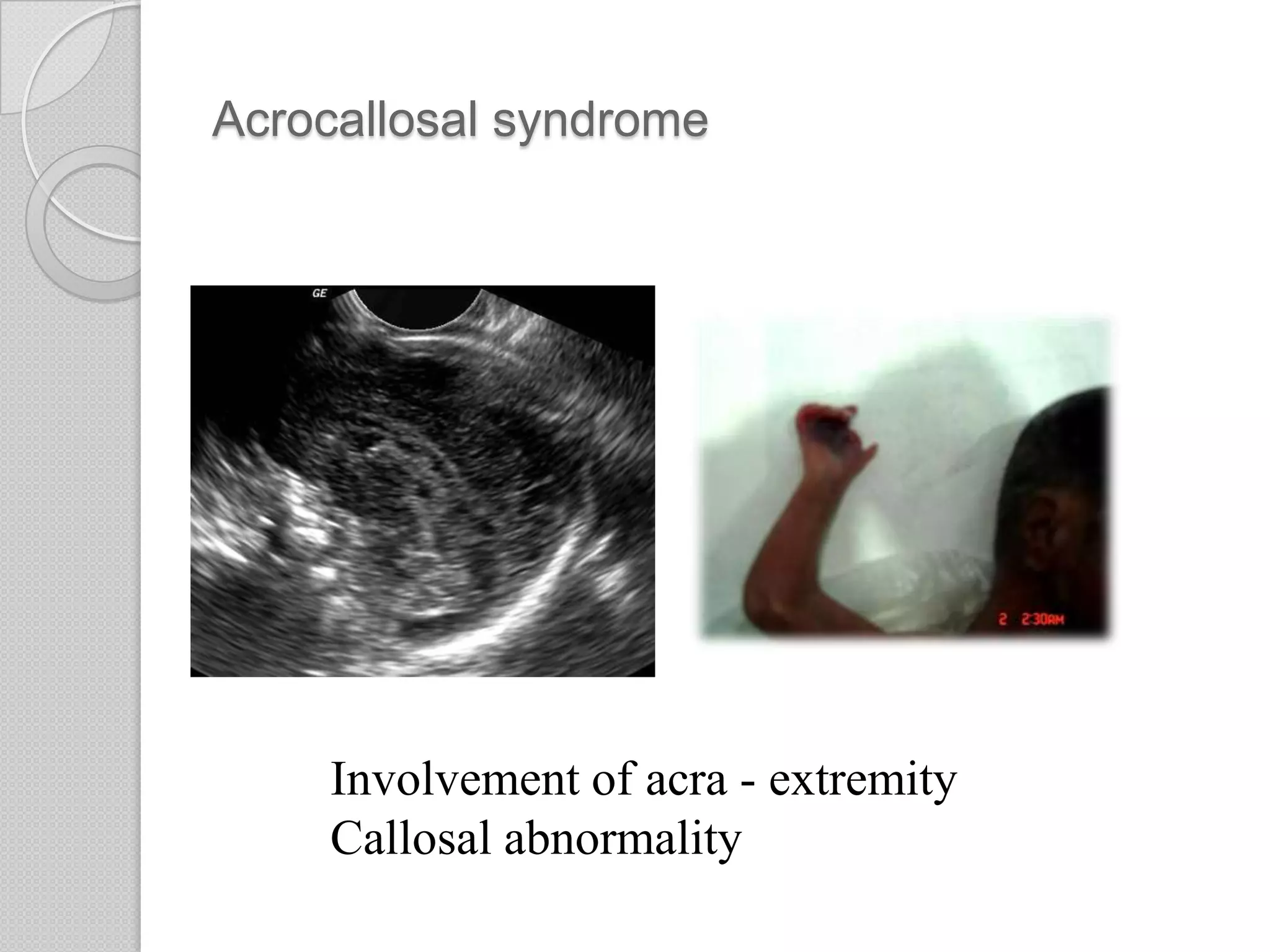 Acrocallosal syndrome
Involvement of acra - extremity
Callosal abnormality
 