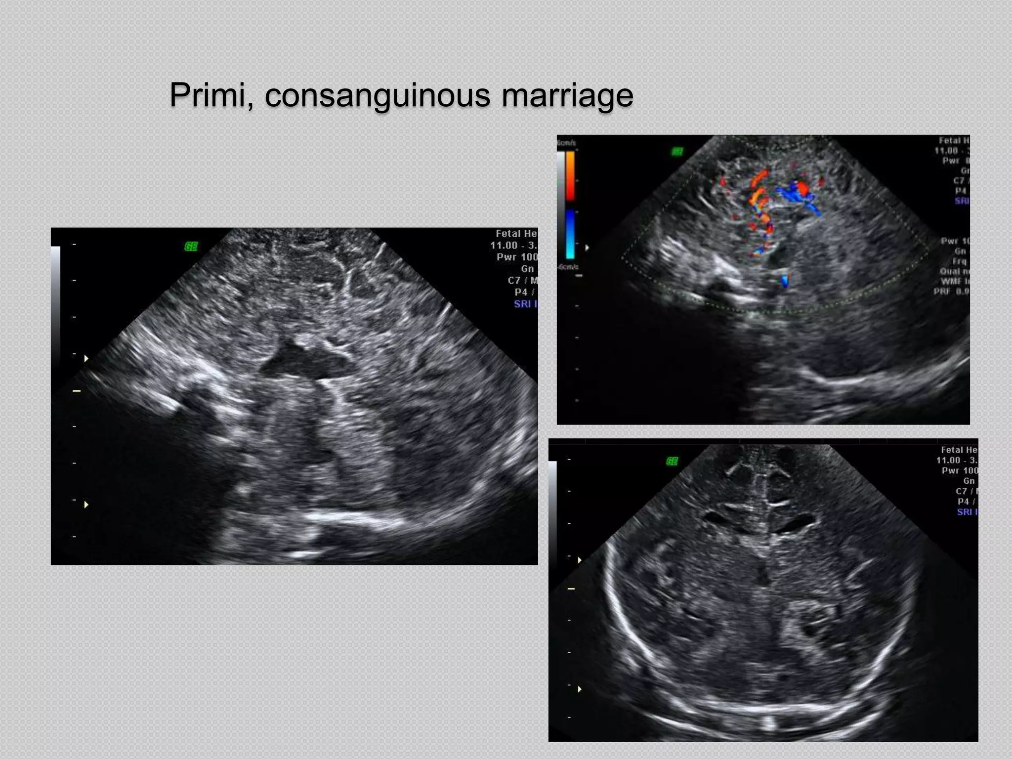 Primi, consanguinous marriage
 