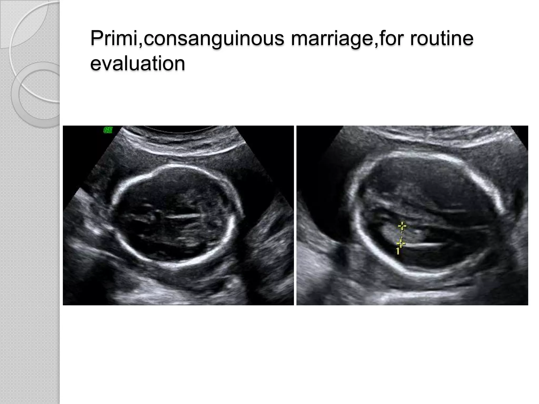 Primi,consanguinous marriage,for routine
evaluation
 