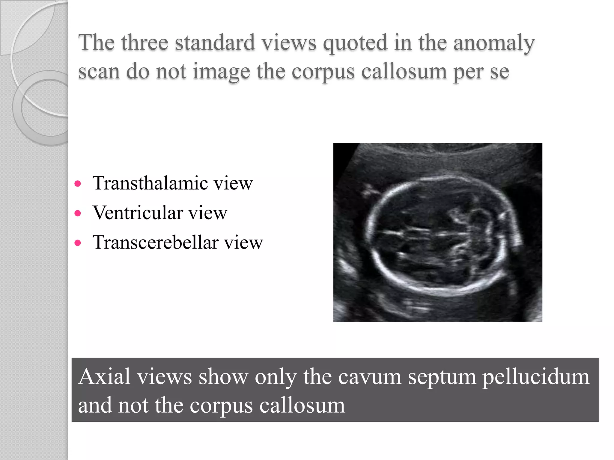 The three standard views quoted in the anomaly
scan do not image the corpus callosum per se
 Transthalamic view
 Ventricular view
 Transcerebellar view
Axial views show only the cavum septum pellucidum
and not the corpus callosum
 