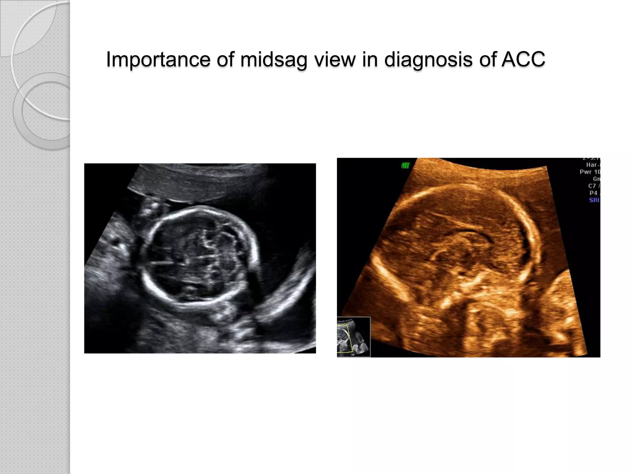 Importance of midsag view in diagnosis of ACC
 