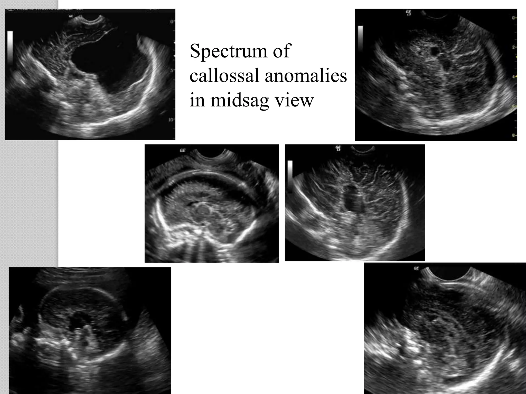 Spectrum of
callossal anomalies
in midsag view
 
