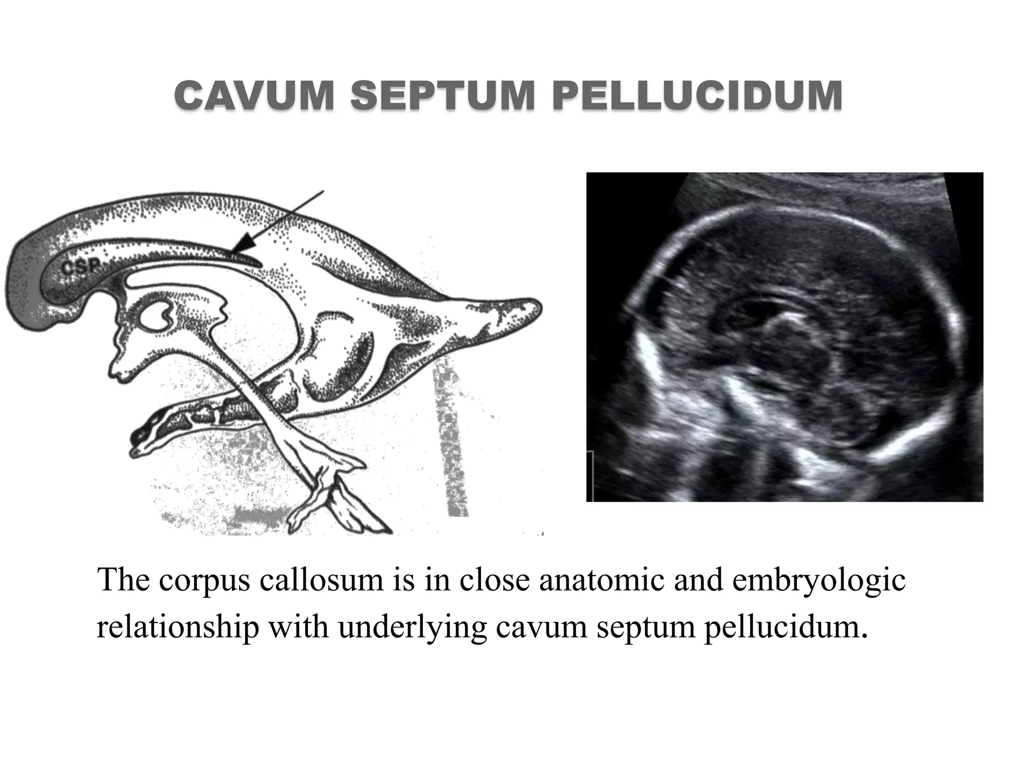 CAVUM SEPTUM PELLUCIDUM
The corpus callosum is in close anatomic and embryologic
relationship with underlying cavum septum pellucidum.
 