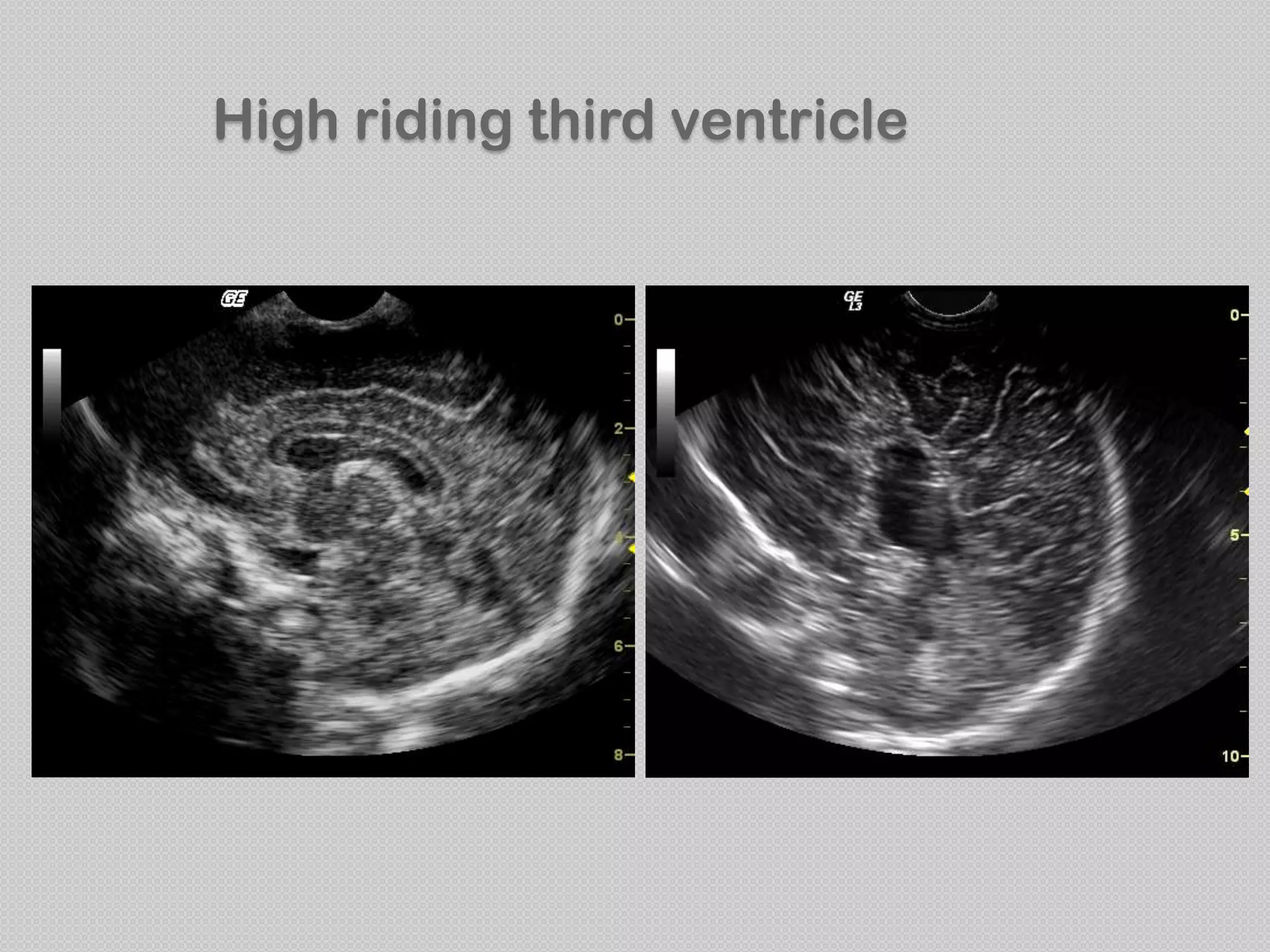 High riding third ventricle
 