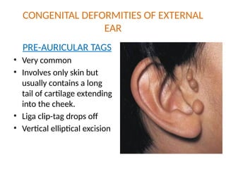Comprehensive Overview of External Ear Abnormalities and Management | PPTX