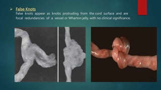 False Knot Rope abnormalities of placenta.pptx