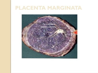 Comprehensive Overview of Placenta and Umbilical Cord Abnormalities in  Pregnancy | PPTX