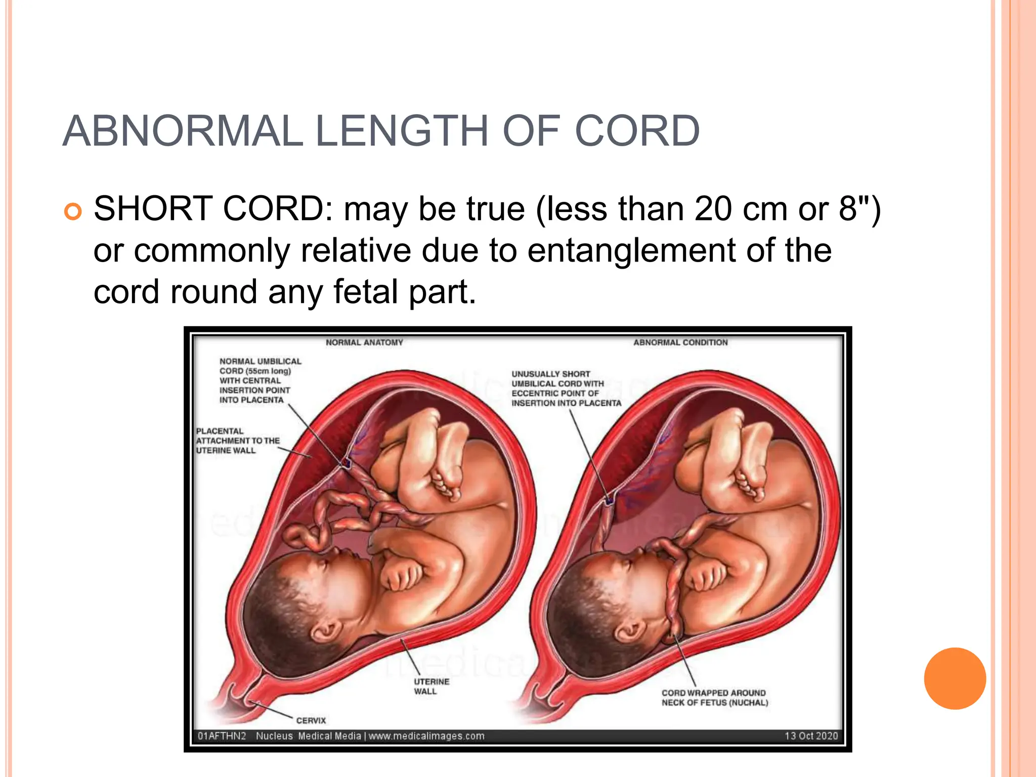 ABNORMALITIES OF PLACENTA AND CORD.pptx