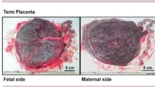 Abnormalities of placenta and cord obg x | PPTX