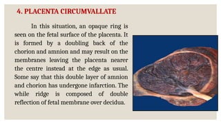 Chorionic Ridge ABNORMALITIES OF PLACENTA & UMBILICAL CORD.pptx