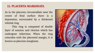 Chorionic Ring ABNORMALITIES OF PLACENTA & UMBILICAL CORD.pptx