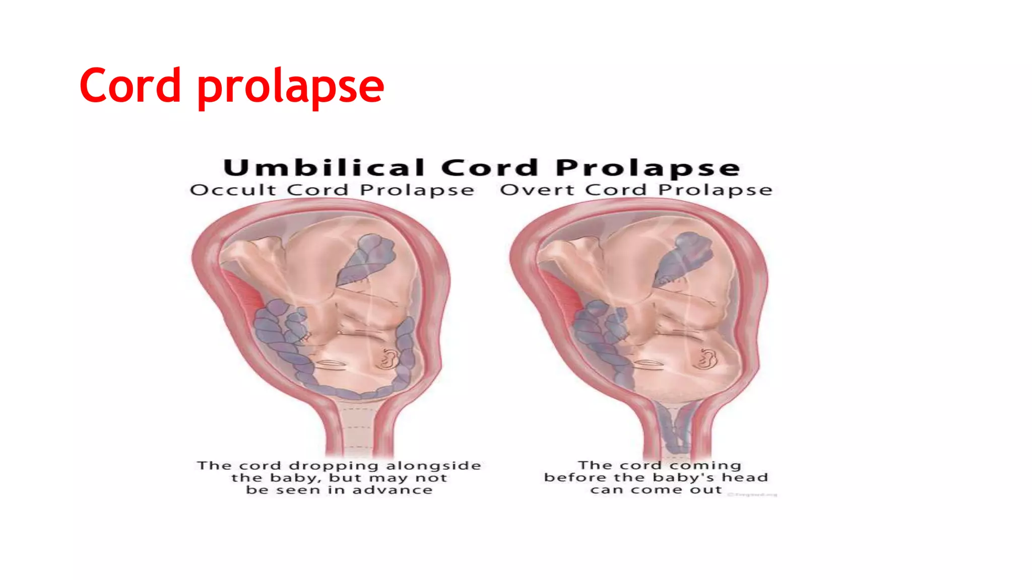 Abnormalities of placenta_cord_and_membrane | PPTX
