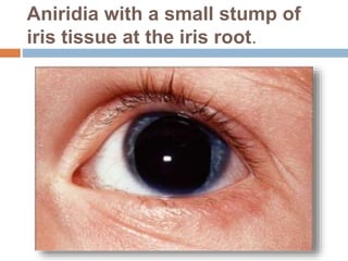 Aniridia with a small stump of
iris tissue at the iris root.
 