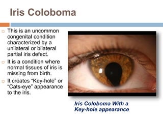 Iris Coloboma
 This is an uncommon
congenital condition
characterized by a
unilateral or bilateral
partial iris defect.
 It is a condition where
normal tissues of iris is
missing from birth.
 It creates “Key-hole” or
“Cats-eye” appearance
to the iris.
Iris Coloboma With a
Key-hole appearance
 