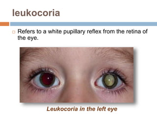 leukocoria
 Refers to a white pupillary reflex from the retina of
the eye.
Leukocoria in the left eye
 