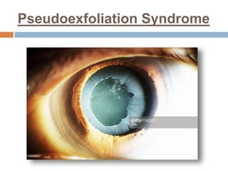 Pseudoexfoliation Syndrome
 