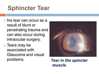 Sphincter Tear
 Iris tear can occur as a
result of blunt or
penetrating trauma and
can also occur during
intraocular surgery.
 Tears may be
associated with
Glaucoma and visual
problems. Tear in the spincter
muscle
 