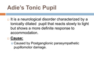 Adie’s Tonic Pupil
 It is a neurological disorder characterized by a
tonically dilated pupil that reacts slowly to light
but shows a more definite response to
accommodation.
 Cause:
 Caused by Postganglionic parasympathetic
pupillomotor damage.
 
