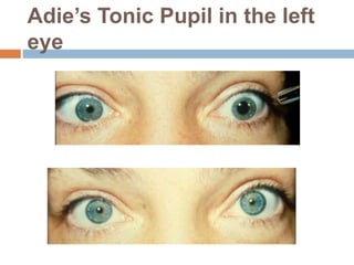 Adie’s Tonic Pupil in the left
eye
 