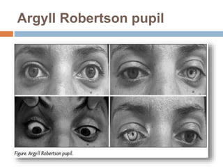 Argyll Robertson pupil
 