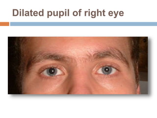 Dilated pupil of right eye
 