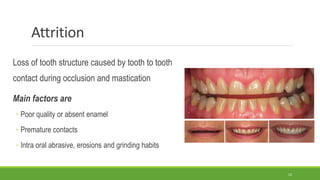 Attrition
Loss of tooth structure caused by tooth to tooth
contact during occlusion and mastication
Main factors are
◦ Poor quality or absent enamel
◦ Premature contacts
◦ Intra oral abrasive, erosions and grinding habits
12
 