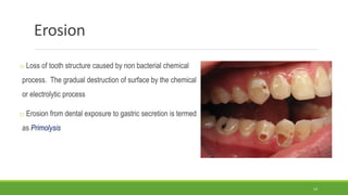 Erosion
o Loss of tooth structure caused by non bacterial chemical
process. The gradual destruction of surface by the chemical
or electrolytic process
o Erosion from dental exposure to gastric secretion is termed
as Primolysis
14
 