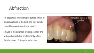 Abfraction
o It appears as wedge shaped defects limited to
the cervical area of the teeth and may closely
resemble cervical abrasion or erosion
o Clues to the diagnosis are deep, narrow and
v shaped defects that predominantly affects
facial surfaces of bicuspids and molars
15
 