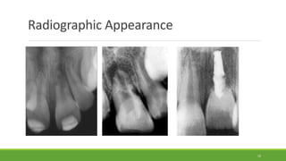 Radiographic Appearance
19
 