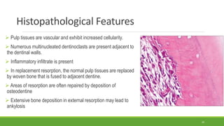 Histopathological Features
 Pulp tissues are vascular and exhibit increased cellularity.
 Numerous multinucleated dentinoclasts are present adjacent to
the dentinal walls.
 Inflammatory infiltrate is present
 In replacement resorption, the normal pulp tissues are replaced
by woven bone that is fused to adjacent dentine.
 Areas of resorption are often repaired by deposition of
osteodentine
 Extensive bone deposition in external resorption may lead to
ankylosis
20
 