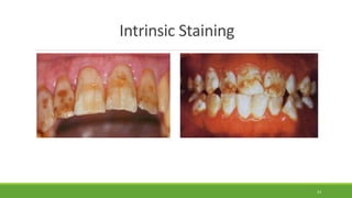 Intrinsic Staining
23
 