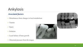Ankylosis
Associated factors
 Disturbances from changes in local metabolism
 Trauma
 Injury
 Irritation
 Local failure of bone growth
 Abnormal pressure from the tongue
26
 