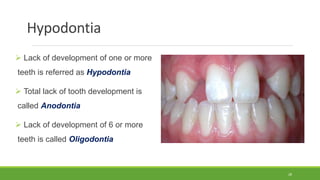 Hypodontia
 Lack of development of one or more
teeth is referred as Hypodontia
 Total lack of tooth development is
called Anodontia
 Lack of development of 6 or more
teeth is called Oligodontia
28
 