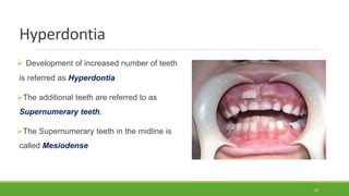 Hyperdontia
 Development of increased number of teeth
is referred as Hyperdontia
The additional teeth are referred to as
Supernumerary teeth.
The Supernumerary teeth in the midline is
called Mesiodense
29
 
