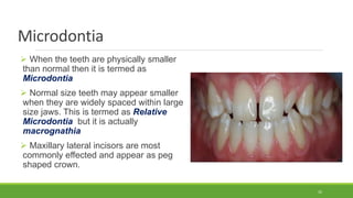 Microdontia
 When the teeth are physically smaller
than normal then it is termed as
Microdontia
 Normal size teeth may appear smaller
when they are widely spaced within large
size jaws. This is termed as Relative
Microdontia but it is actually
macrognathia
 Maxillary lateral incisors are most
commonly effected and appear as peg
shaped crown.
32
 