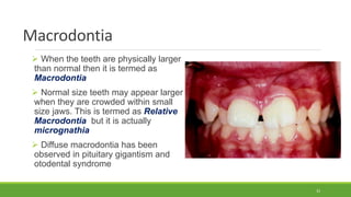 Macrodontia
 When the teeth are physically larger
than normal then it is termed as
Macrodontia
 Normal size teeth may appear larger
when they are crowded within small
size jaws. This is termed as Relative
Macrodontia but it is actually
micrognathia
 Diffuse macrodontia has been
observed in pituitary gigantism and
otodental syndrome
33
 