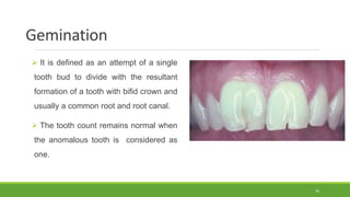 Gemination
 It is defined as an attempt of a single
tooth bud to divide with the resultant
formation of a tooth with bifid crown and
usually a common root and root canal.
 The tooth count remains normal when
the anomalous tooth is considered as
one.
34
 