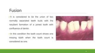 Fusion
It is considered to be the union of two
normally separated teeth buds with the
resultant formation of a joined tooth with
confluence of dentin.
In this condition the tooth count shows one
missing tooth when the tooth count is
considered as one.
35
 
