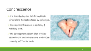 Concrescence
It is described as two fully formed teeth
joined along the root surfaces by cementum.
More commonly present in posterior &
maxillary teeth.
The development pattern often involves
second molar tooth where roots are in close
proximity to 3rd molar tooth.
36
 