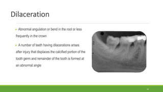 Dilaceration
 Abnormal angulation or bend in the root or less
frequently in the crown
 A number of teeth having dilacerations arises
after injury that displaces the calcified portion of the
tooth germ and remainder of the tooth is formed at
an abnormal angle
44
 