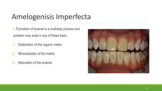 Amelogenisis Imperfecta
 Formation of enamel is a multistep process and
problem may arise in any of these them.
1) Elaboration of the organic matrix
2) Mineralization of the matrix
3) Maturation of the enamel.
47
 
