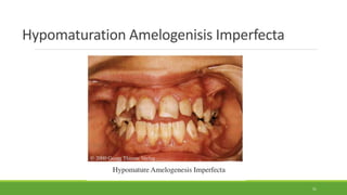 Hypomaturation Amelogenisis Imperfecta
51
 