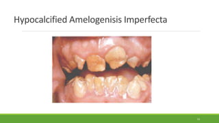 Hypocalcified Amelogenisis Imperfecta
53
 