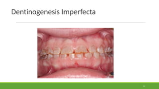 Dentinogenesis Imperfecta
57
 