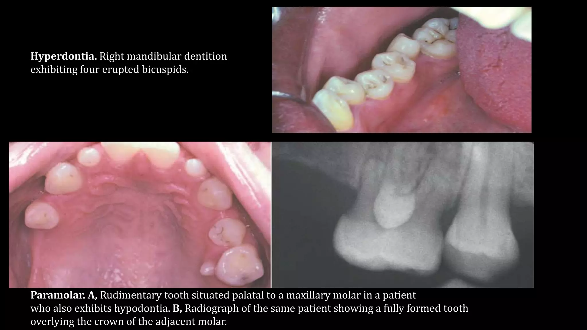 Abnormalities of teeth | PPTX