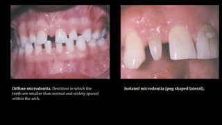 Micro Tooth Abnormalities of teeth | PPTX