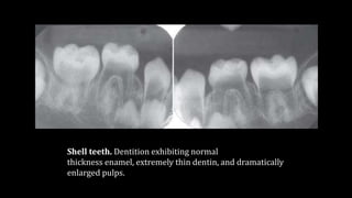 Abnormalities of teeth | PPTX