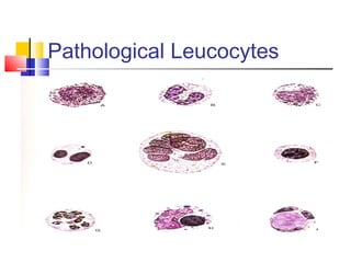 Pathological Leucocytes
 
